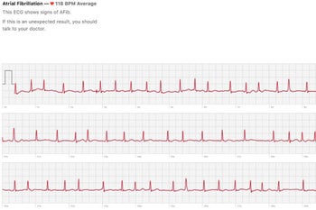 ECG sensor on the Apple Watch Series 4 has already saved a life