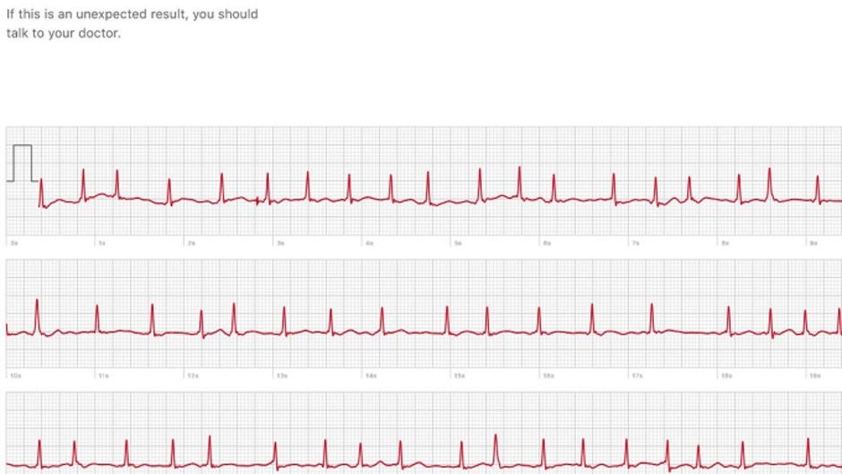 ECG sensor on the Apple Watch Series 4 has already saved a life