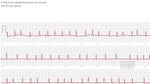 ECG sensor on the Apple Watch Series 4 has already saved a life