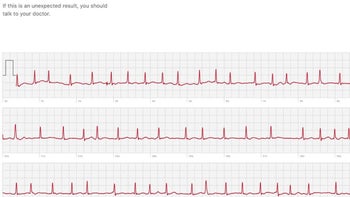 ECG sensor on the Apple Watch Series 4 has already saved a life