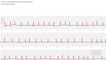ECG sensor on the Apple Watch Series 4 has already saved a life