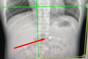 7-year-old swallows AirPod, rushed to hospital