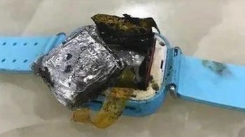 Smartwatch explodes causing third-degree burns on 4-year-old girl
