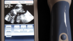 MobiUS turns your smartphone into an ultrasound machine
