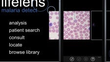 Hope for malaria-infected: Lifelens app gives 94% accurate diagnosis on your smartphone from a drop of blood
