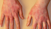 Allergy to the Apple iPad could leave you with a rash