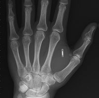 Taking “being connected” to the next level: Man implants NFC chip into his hand