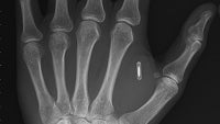 Taking “being connected” to the next level: Man implants NFC chip into his hand