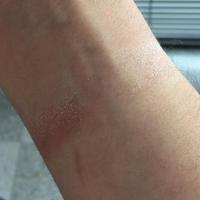 allergic reaction to apple watch band