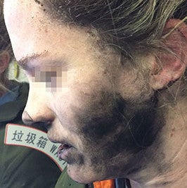 Another battery explosion on a plane causes injuries to woman