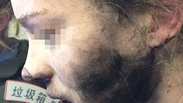 Another battery explosion on a plane causes burns to woman's face