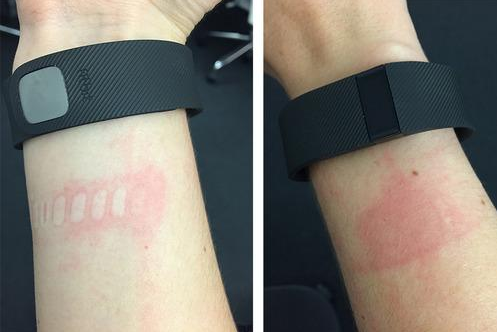The FitBit Charge is leaving some users with irritated skin - FitBit Charge wearers suffering from irritated skin