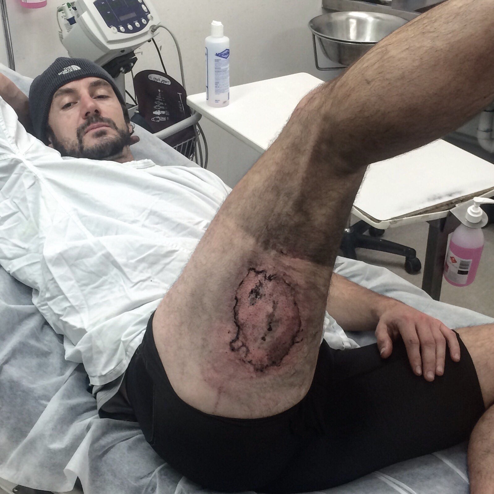 Clear's iPhone exploded in back pocket following a minor bike fall. Skin graft surgery was required - iPhone 6 explodes following minor bike fall, leaves man with third-degree burns