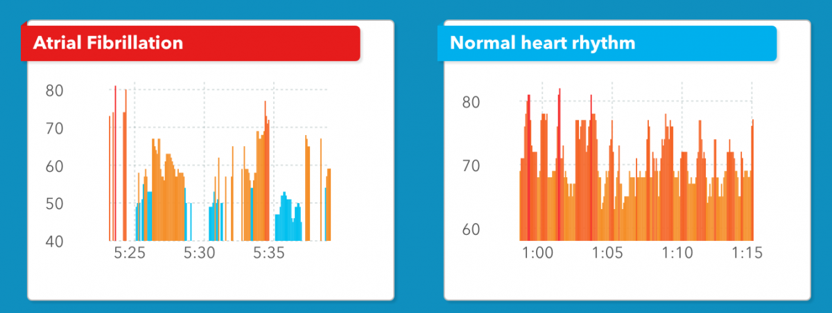 &amp;#1058;he difference in the heart rhythms of a user experiencing atrial fibrillation (left) and one with a normally working heart - Study: Apple Watch is 97% accurate when detecting one of the common causes of heart failure