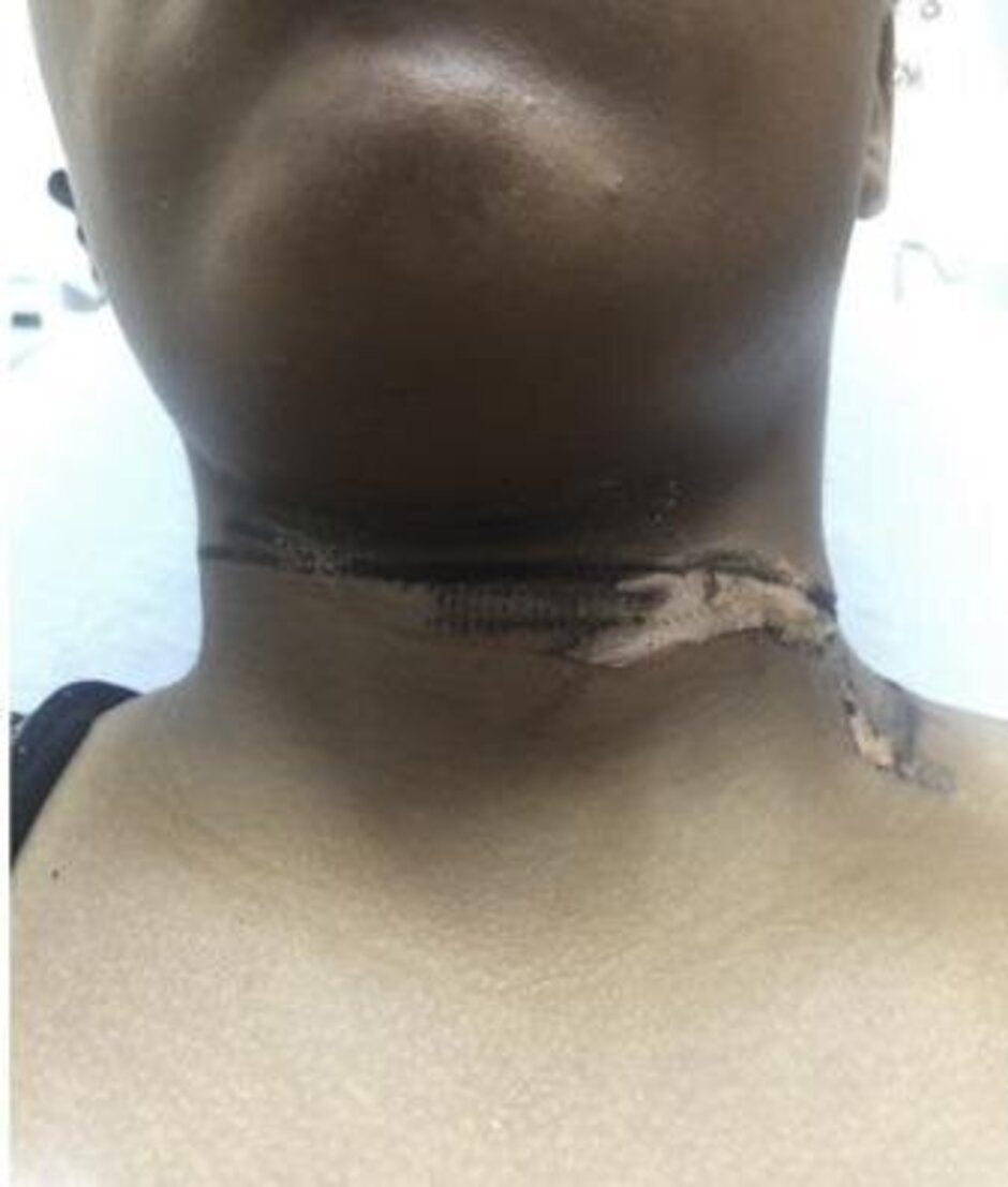 Woman burned around the neck by a generic Apple iPhone charger - If you use a generic smartphone charger, read this before it&#039;s too late