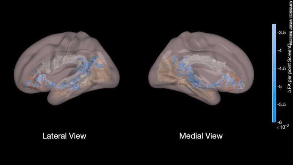 The blue color in this photo shows areas of white matter in the brain that are underdeveloped because of excessive screen time. Courtesy of Dr. John Hutton - Study reveals why tablets and phones are dangerous babysitters