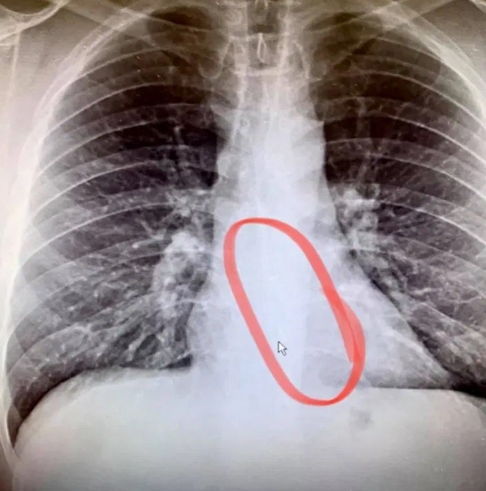 X-ray taken in the hospital shows the missing AirPod in Gauthier's esophagus - PSA: Don't ever wear your AirPods at bedtime; here's why