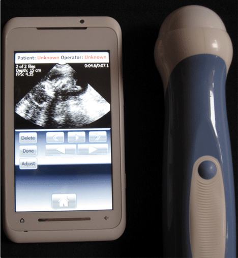 MobiUS turns your smartphone into an ultrasound machine