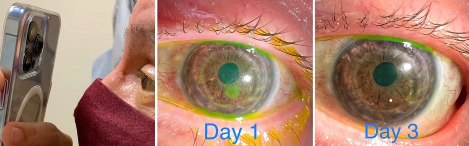 Opthamologist Tommy Korn uses the Macro mode on the iPhone 13 Pro Max to treat a patient with corneal abrasions - Doctor uses 5G iPhone 13 Pro's Macro mode to examine patients' eyes