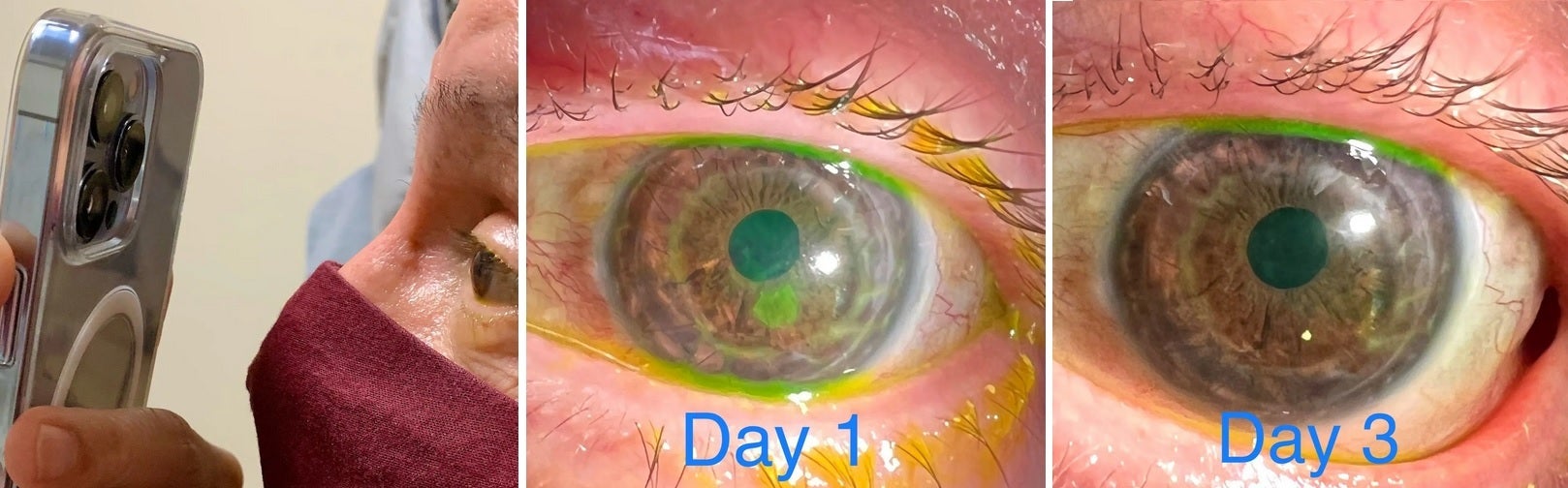 Opthamologist Tommy Korn uses the Macro mode on the iPhone 13 Pro Max to treat a patient with corneal abrasions - Doctor uses 5G iPhone 13 Pro&#039;s Macro mode to examine patients&#039; eyes