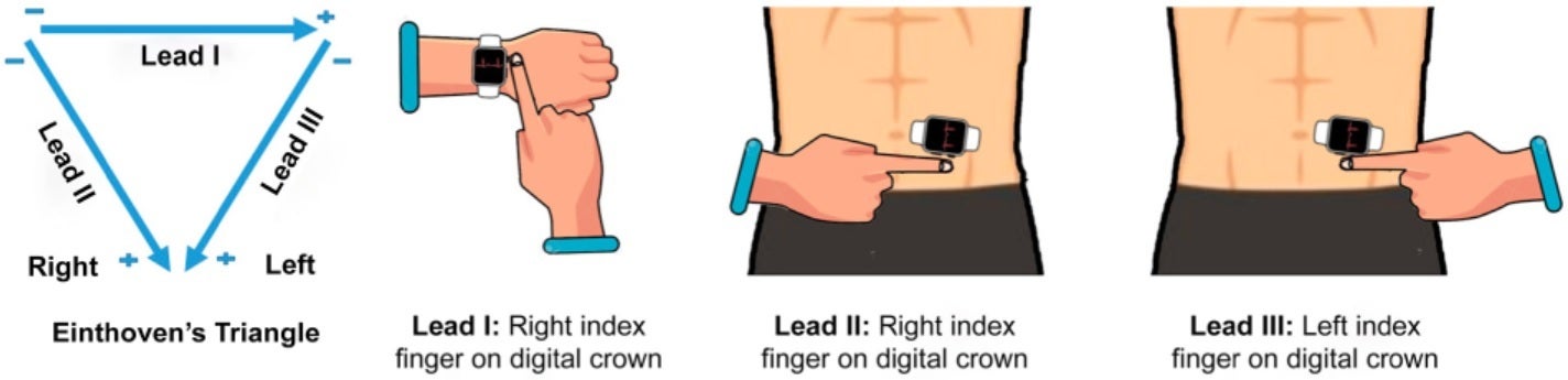 Ikuti diagram untuk mendapatkan EKG tiga sadapan yang akurat dari Apple Watch Anda - Penelitian menunjukkan bahwa Apple Watch dapat memperingatkan pengguna tentang serangan jantung