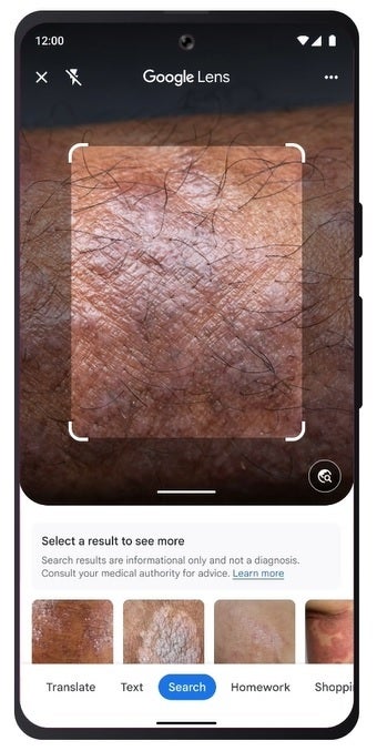 Find out what skin condition you have using Google Lens - What's wrong with your skin? Ask Dr. Google Lens