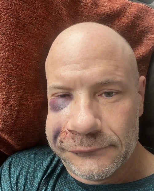 Self-conscious about his appearance, Zellinger wouldn't leave his home for three days after the accident - Man credits Apple Watch for saving his life after accident left him looking like a "monster"
