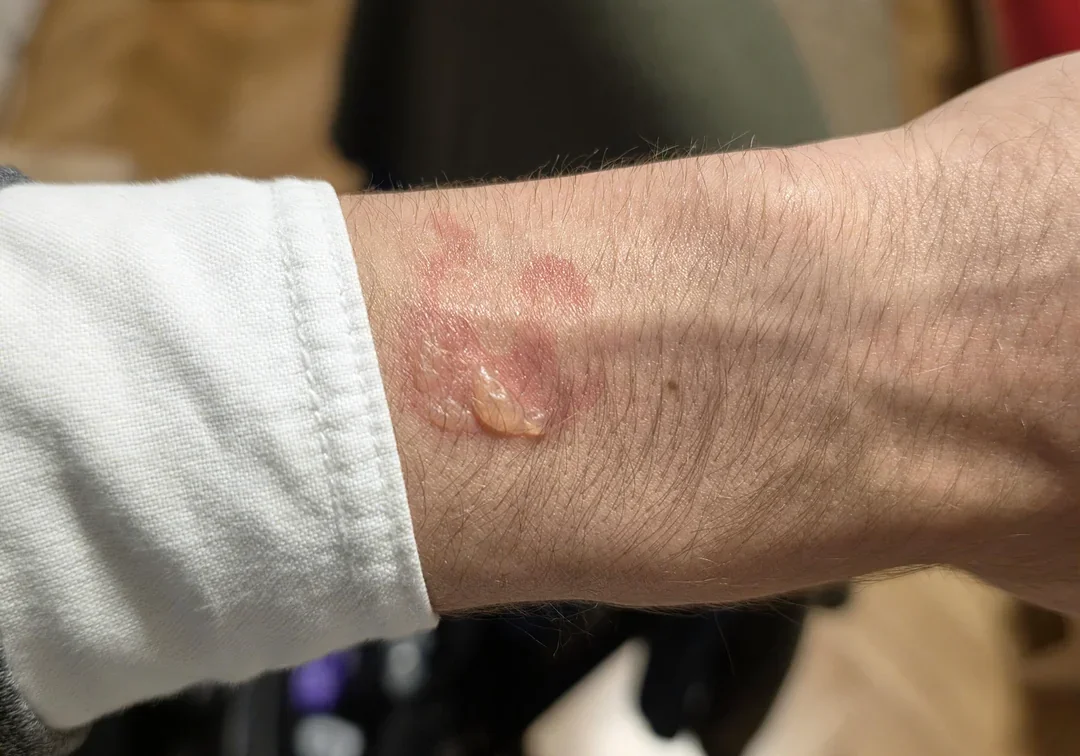 Not fun at all. | Image by Reddit user ksima_03 - Here we go again: some Galaxy Watch models are burning people's wrists